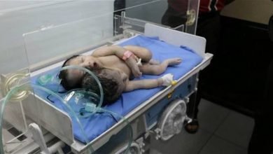 صورة لاول مرة على مستوى العراق  ذي قار تشهد ولادة طفل برأسيين